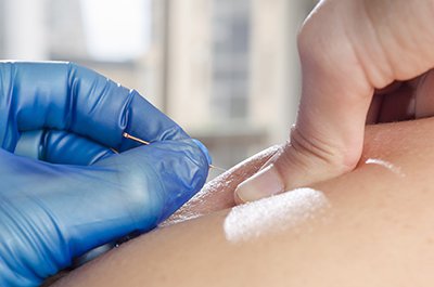 Hands of physical therapist inserting dry needle in a man's shoulder.